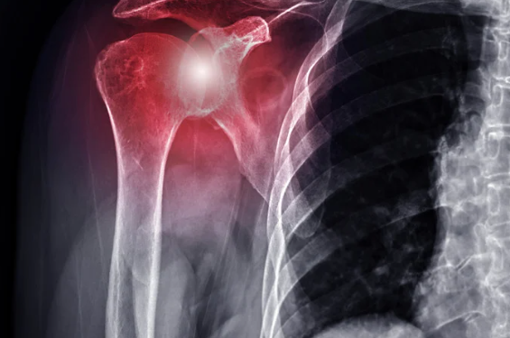 Frozen Shoulder Treatment: How Physical Therapy Restores Mobility and Reduces Pain